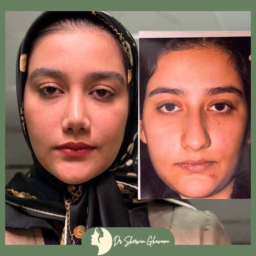 جراحی بینی گوشتی جراحی بینی گوشتی