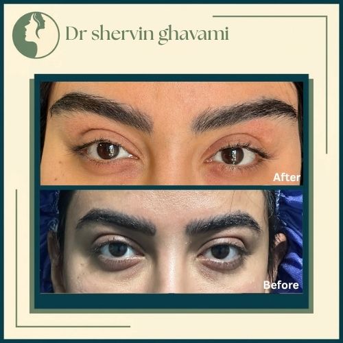 بلفاروپلاستی و لیفت شقیقه