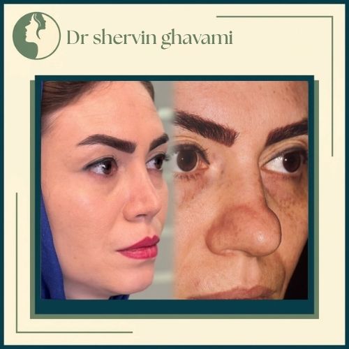 جراحی بینی