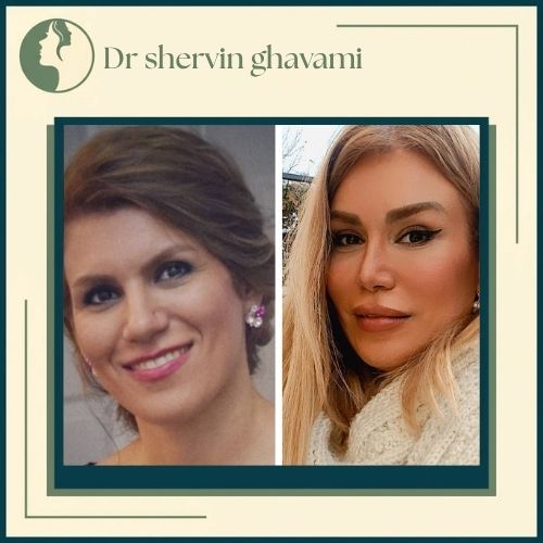 جراحی بینی