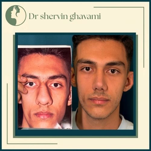 جراحی بینی گوشتی