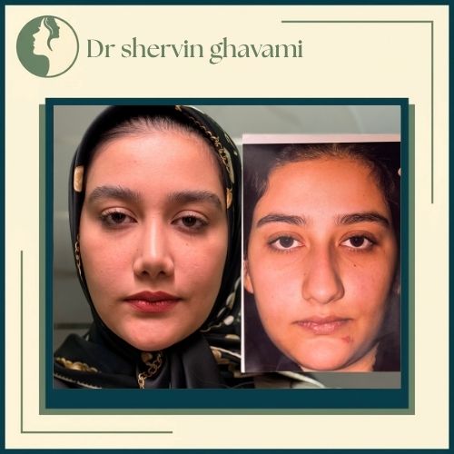 جراحی بینی گوشتی